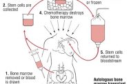 बोन मैरो ट्रांसप्लांटेशन से युवक को थैलसीमिया से मिली मुक्ति