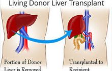 देश में पहली बार इस प्रक्रिया से हुआ सफल लिवर प्रत्यारोपण