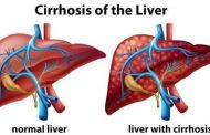 वायरल इंफेक्शन हेपेटाइटिस सी और बी लिवर सिरोसिस के मुख्य वजहों में से एक