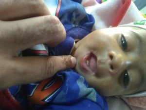 केजीएमयू : एक माह के बच्चे को था मुंह में ट्यूमर, डॉक्टरों ने ऐसे दी मुस्कान